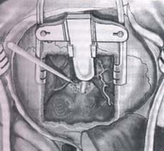 Fresado de la porción más medial del conducto auditivo interno Fresado de la porción más medial del conducto auditivo interno