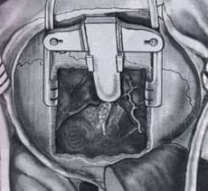 Exposición del contenido conducto auditivo interno Exposición del contenido conducto auditivo interno