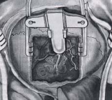 Extirpación total de un neurinoma del acústico intracanalicular Extirpación total de un neurinoma del acústico intracanalicular