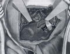 Abordaje de fosa media ampliado Abordaje de fosa media ampliado