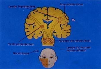 Parálisis facial supranuclear