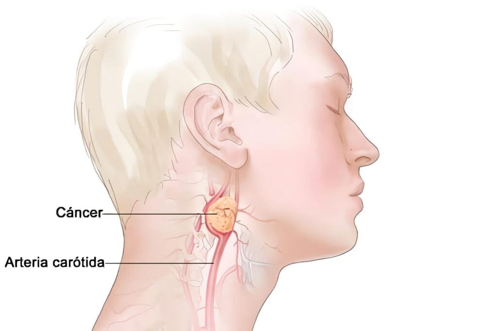 Paragangliomas del Cuerpo Carotídeo