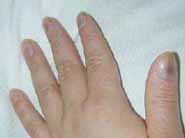 Cambios ungueales por cloroquina Cambios ungueales por cloroquina