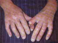 Esclerodactilia severa