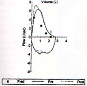 Curva flujo volumen normal Curva flujo volumen normal