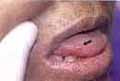 Ulcera de borde eritematoso en la mucosa lingual en un paciente con Artritis reumatoide