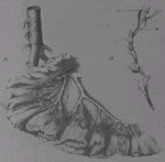 Dibujo del caso descrito por Rokitansky de Wenzel Plohner. Dibujo del caso descrito por Rokitansky de Wenzel Plohner.