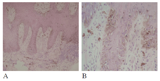 Epidermis con hiperplasia