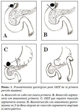 Procedimientos quirúrgicos para GIST 
