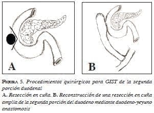 Procedimientos quirúrgicos para GIST de la segunda porción duodenal  Procedimientos quirúrgicos para GIST de la segunda porción duodenal
