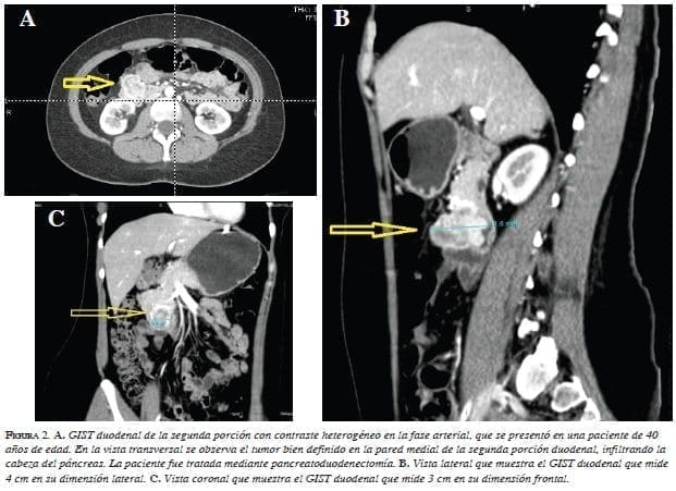 GIST duodenal de la segunda porción con contraste heterogéneo en la fase arterial, GIST duodenal de la segunda porción con contraste heterogéneo en la fase arterial,
