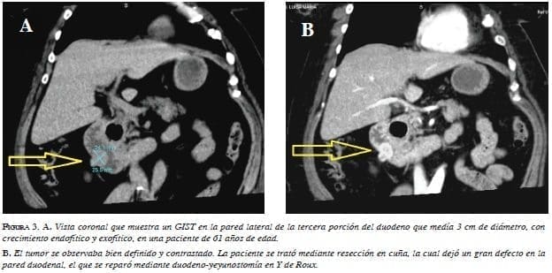 Vista coronal que muestra un GIST en la pared lateral de la tercera porción del duodeno Vista coronal que muestra un GIST en la pared lateral de la tercera porción del duodeno