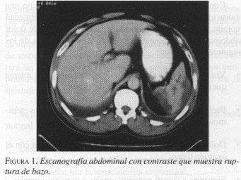 Escanografía Abdominal con contraste que muestra Ruptura de Bazo Escanografía Abdominal con contraste que muestra Ruptura de Bazo
