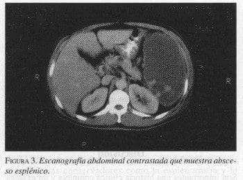 Escanografía Abdominal contrastada que muestra Absceso Esplénico Escanografía Abdominal contrastada que muestra Absceso Esplénico