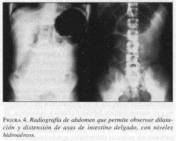 Asas de intestino delgado, con niveles Hidroaéreos Asas de intestino delgado, con niveles Hidroaéreos