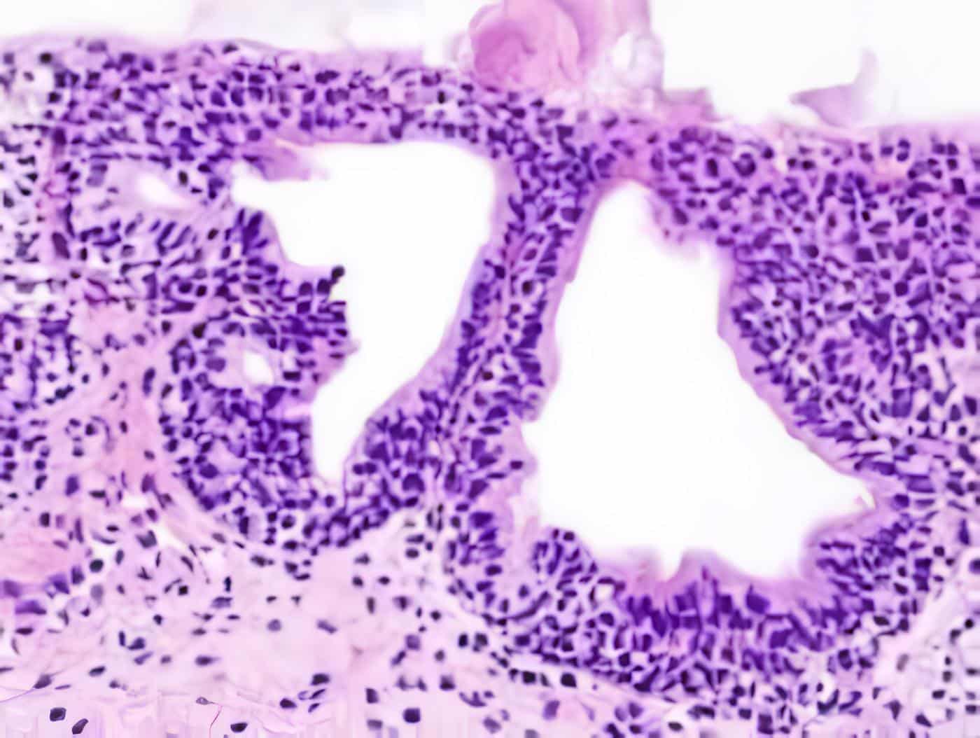vu-081 - Cistitis Glandular
