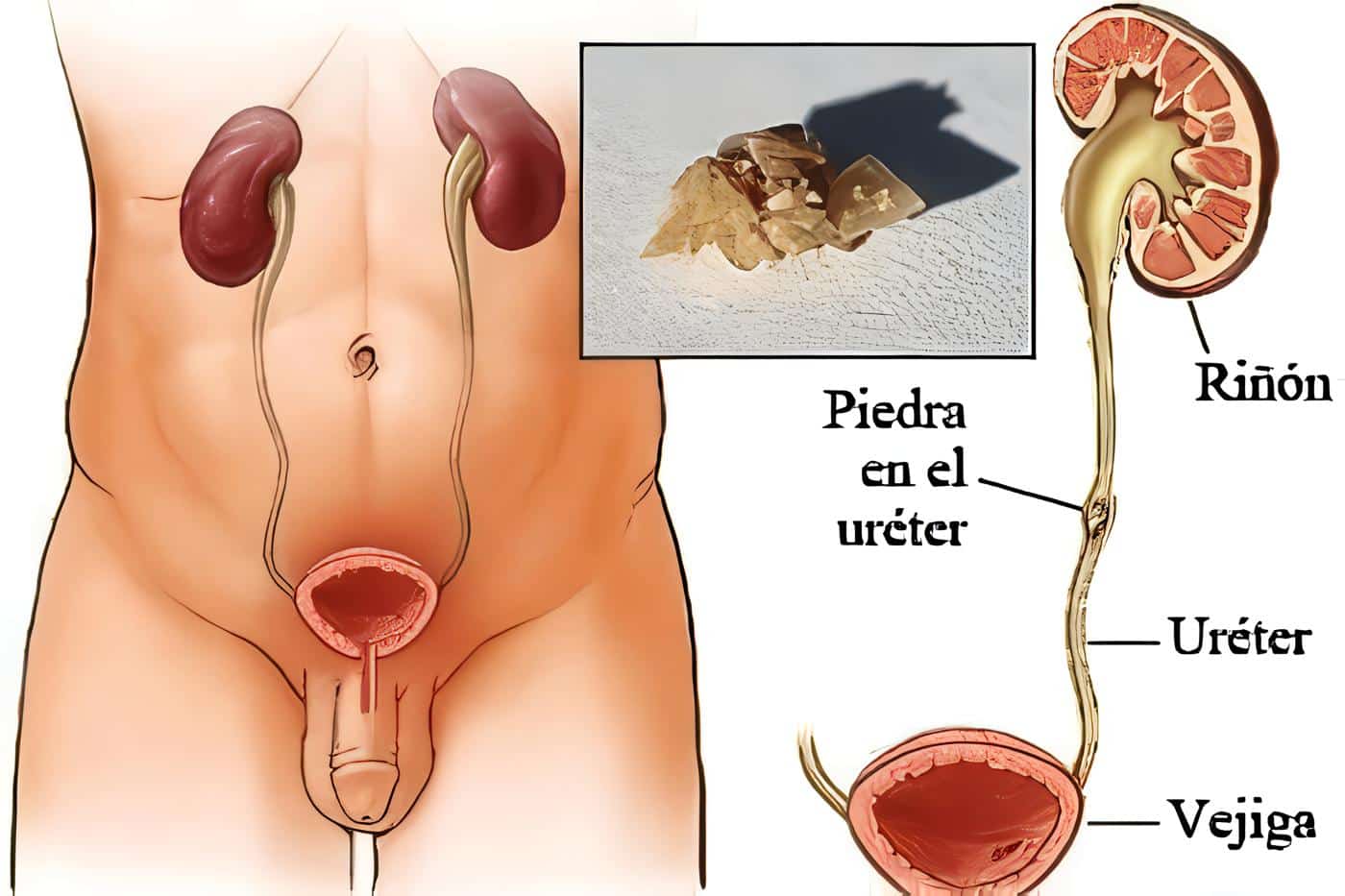 Coledocolitiasis