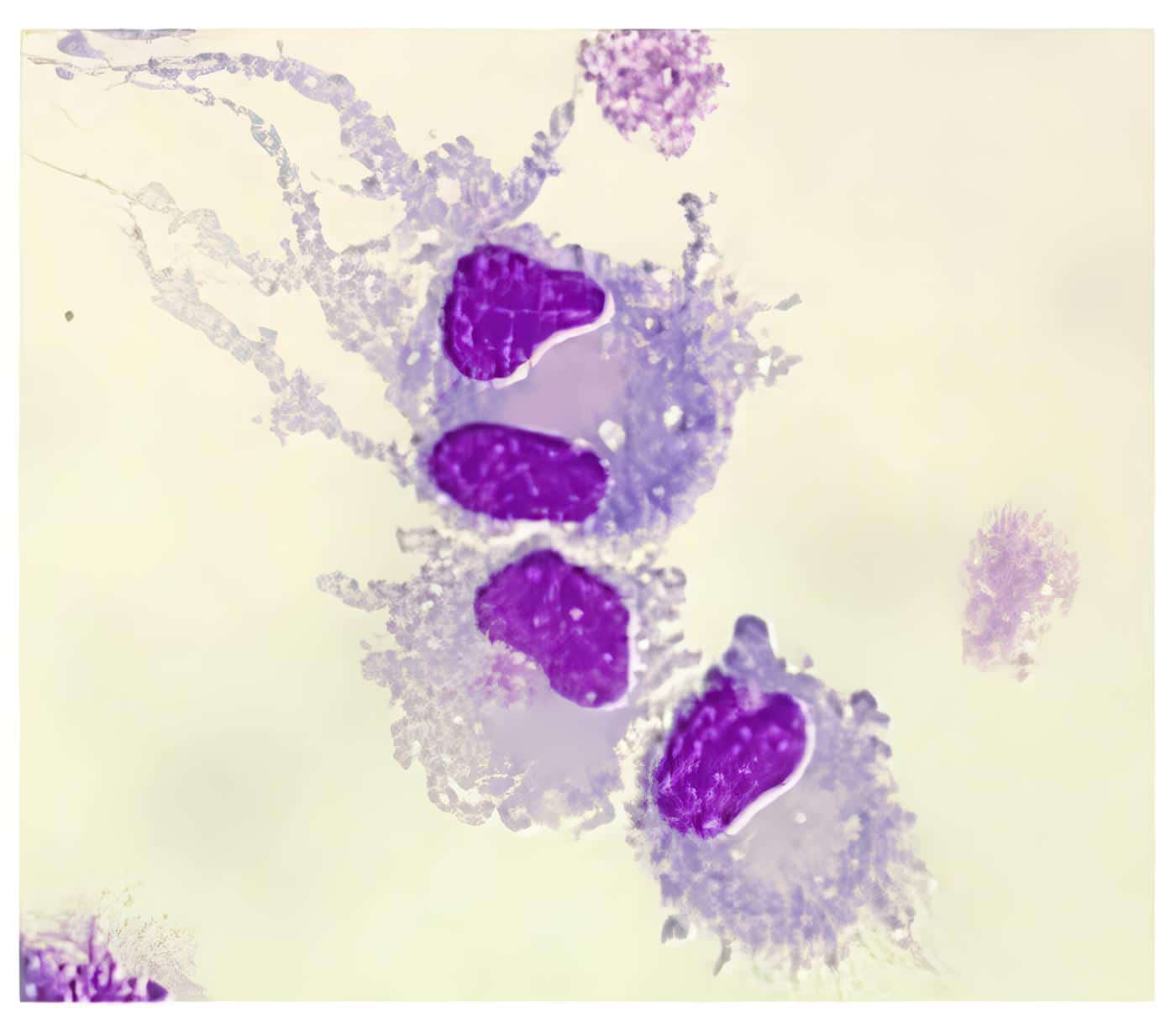 vu-091 - Mielitis transversa