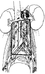 Envolvimiento ganglionar canceroso Envolvimiento ganglionar canceroso