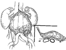 Zonas suprahiliares de enteroaortocavales y paraaórticos respectivamente. Zonas suprahiliares de enteroaortocavales y paraaórticos respectivamente.