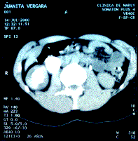 Escanografía de abdomen
