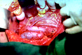Disección detallada de la vena cava y vasos gonadales Disección detallada de la vena cava y vasos gonadales