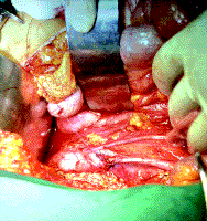 Corrección de la patología una Pieloplasia tipo Anderson Hines Corrección de la patología una Pieloplasia tipo Anderson Hines