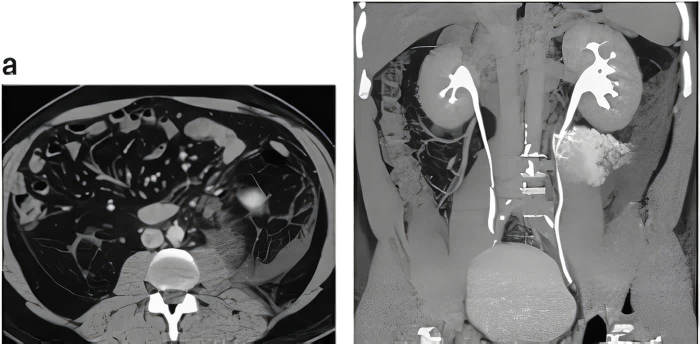 vu-111 - Ureter Retrocavo