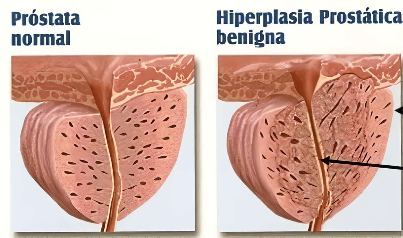vu101-Hipertrofia Prostática Benigna