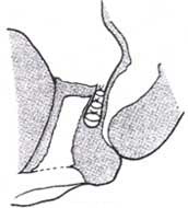 Vagina en una posición anatómica Vagina en una posición anatómica