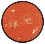 Retinopatía Diabética Retinopatía Diabética