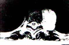 Feocromocitoma extra-advenal. Feocromocitoma extra-advenal.