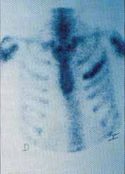 Hipercaptación del trazado Hipercaptación del trazado