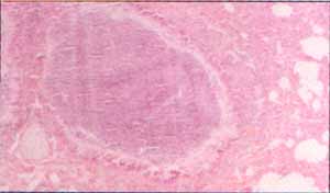 Bronquilo dilatado, con pérdida del cartílago Bronquilo dilatado, con pérdida del cartílago