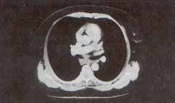 TAC helicoidal, de ganglios anormalmente prominentes en la región subcarinal TAC helicoidal, de ganglios anormalmente prominentes en la región subcarinal