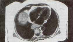 Resonancia magnética, en el plano axial, en secuencia de pulso Spin Echo T1 Resonancia magnética, en el plano axial, en secuencia de pulso Spin Echo T1