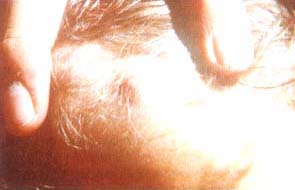 SHIEIR en el cuero cabelludo SHIEIR en el cuero cabelludo