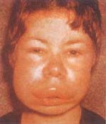 Angioedema hereditario (Deficiencia C1INH) Angioedema hereditario (Deficiencia C1INH)