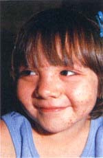 SHIEIR en mejillas y mentón SHIEIR en mejillas y mentón