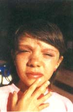 Facies dismórfica característica del SHIEIR Facies dismórfica característica del SHIEIR