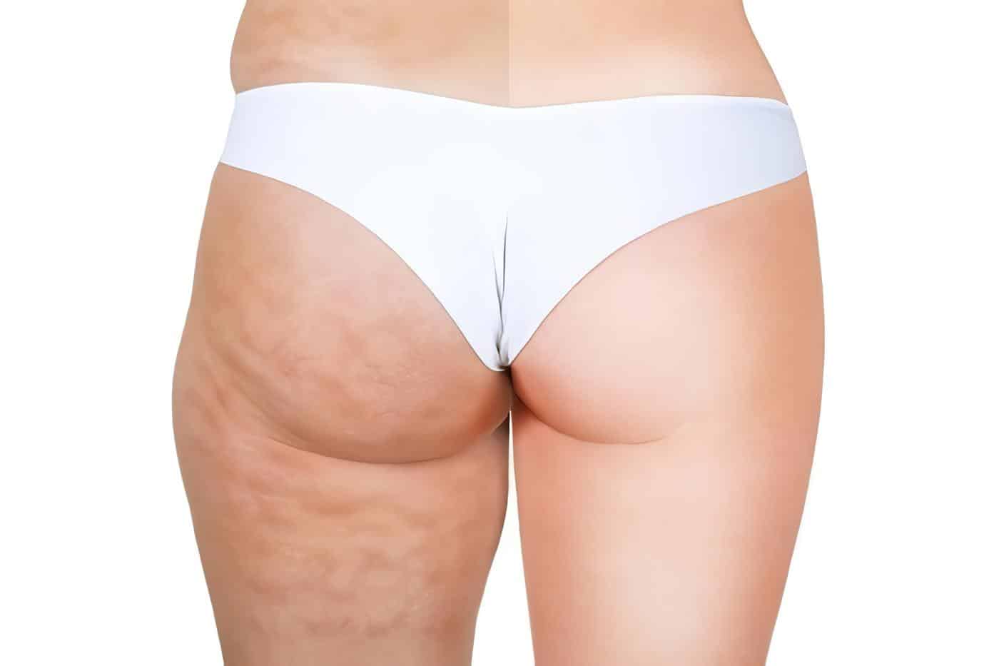 Clases de celulitis