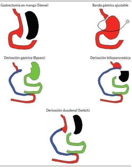 Esquema de cirugía bariátrica y metabólica