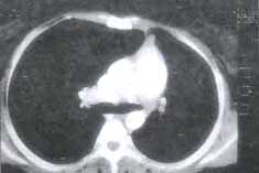 TAC de tórax. TAC de tórax.