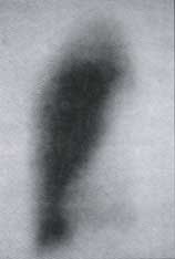 Gammagrafia de perfusión pulmonar Gammagrafia de perfusión pulmonar