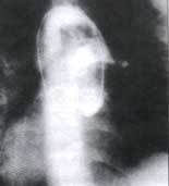 Arteriografia pulmonar Arteriografia pulmonar