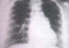 Rx de tórax Rx de tórax