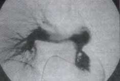 Arteriografia pulmonar Arteriografia pulmonar