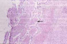 Vista panorámica del pulmón con cambios necróticos extensos