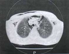 TAC helicoidal TAC helicoidal