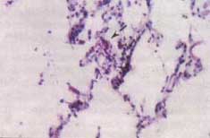 Áreas pulmonares no necróticas con septos alveolares